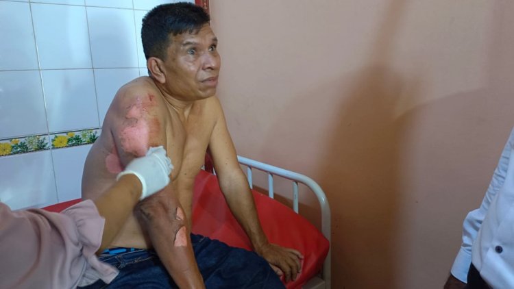 Api Kompor Sambar Tabung Gas, Korban Ansor Siregar Luka Bakar